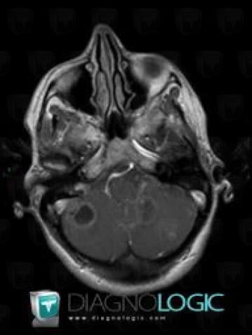 Metastasis, Posterior fossa, MRI