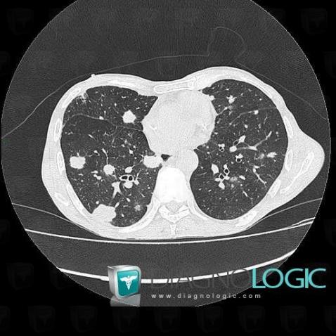 Metastasis, Pulmonary parenchyma, CT