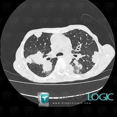 Metastasis, Pulmonary parenchyma, CT