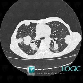 Metastasis, Pulmonary parenchyma, CT