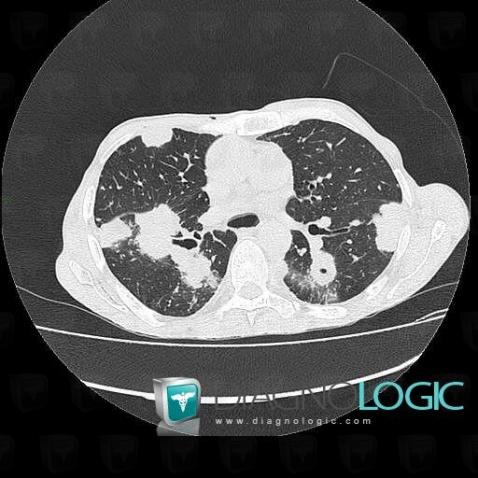 Metastasis, Pulmonary parenchyma, CT