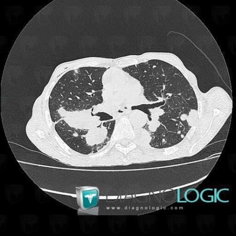 Metastasis, Pulmonary parenchyma, CT