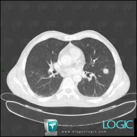 Metastasis, Pulmonary parenchyma, CT