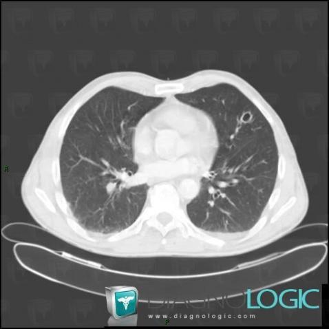 Metastasis, Pulmonary parenchyma, CT