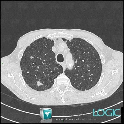 Metastasis, Pulmonary parenchyma, CT