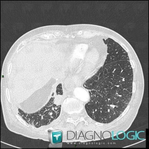 Metastasis, Pulmonary parenchyma, CT