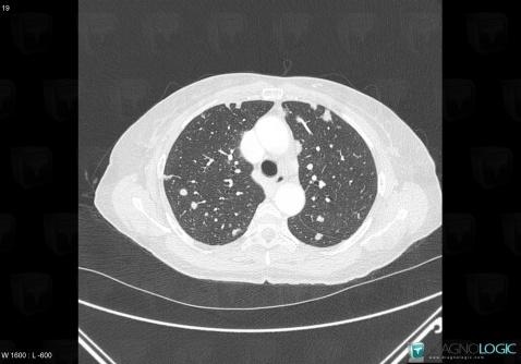 Metastasis, Pulmonary parenchyma, CT