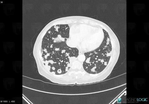 Metastasis, Pulmonary parenchyma, CT