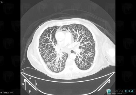 Metastasis, Pulmonary parenchyma, CT