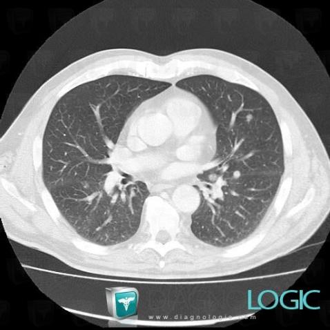 Metastasis, Pulmonary parenchyma, CT