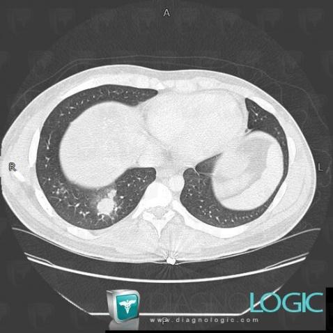 Metastasis, Pulmonary parenchyma, CT