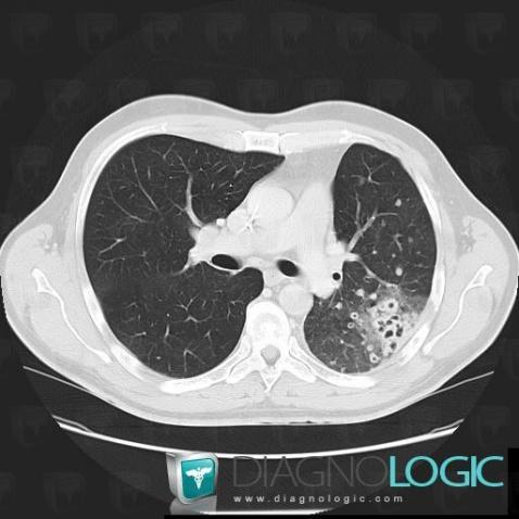 Metastasis, Pulmonary parenchyma, CT