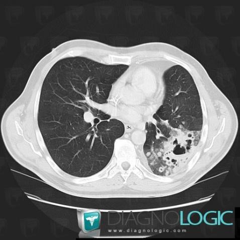 Metastasis, Pulmonary parenchyma, CT