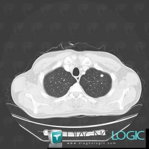 Metastasis, Pulmonary parenchyma, CT