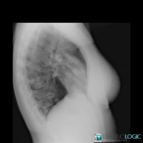 Metastasis, Pulmonary parenchyma, X rays
