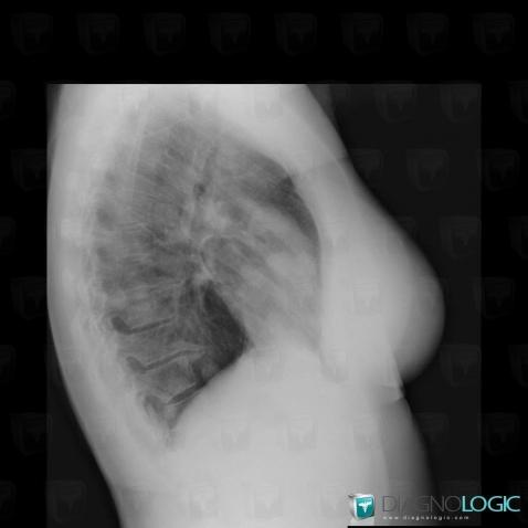 Metastasis, Pulmonary parenchyma, X rays