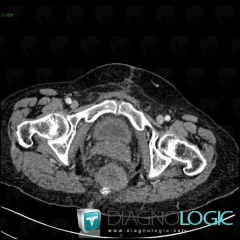 Metastasis, Rectum, CT