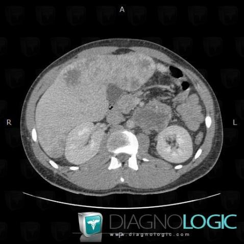 Metastasis, Retroperitoneum, CT