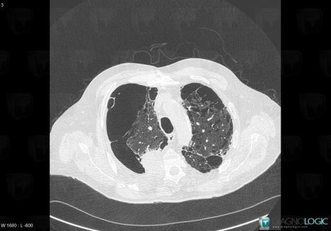 Metastasis, Ribs, CT