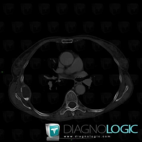 Metastasis, Ribs, CT