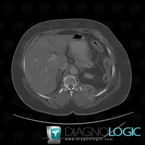 Metastasis, Ribs, CT