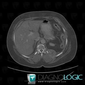 Metastasis, Ribs, CT