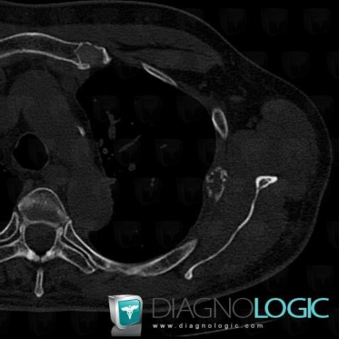 Metastasis, Ribs, CT