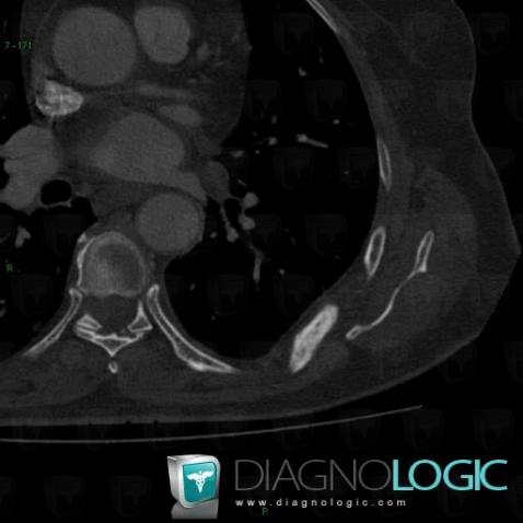 Metastasis, Ribs, CT