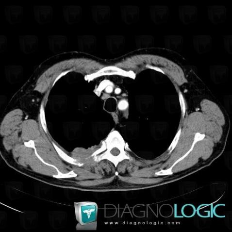 Metastasis, Ribs, CT