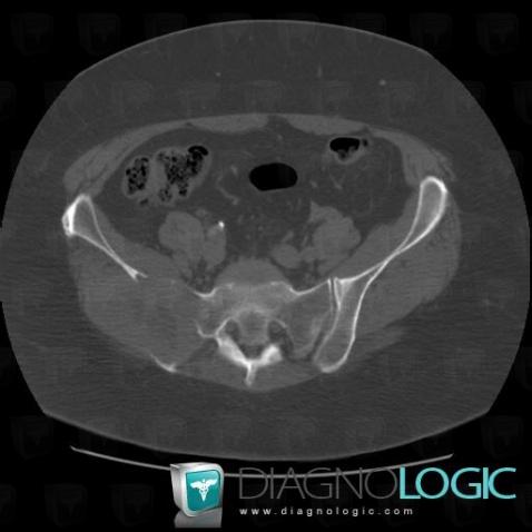 Metastasis, Sacro iliac joint, CT