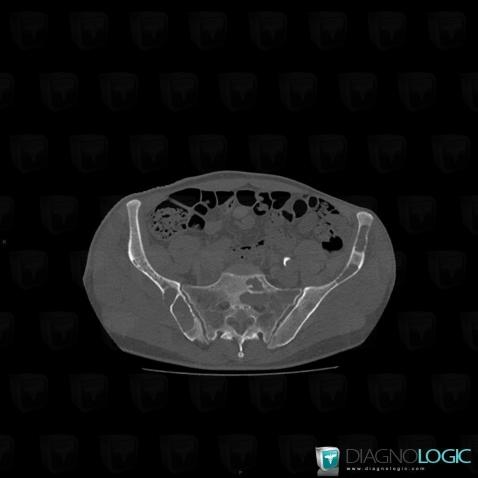 Metastasis, Sacrum / Coccyx, CT