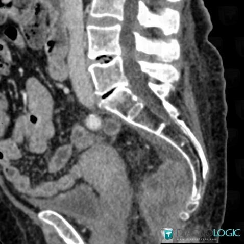 Metastasis, Sacrum / Coccyx, CT