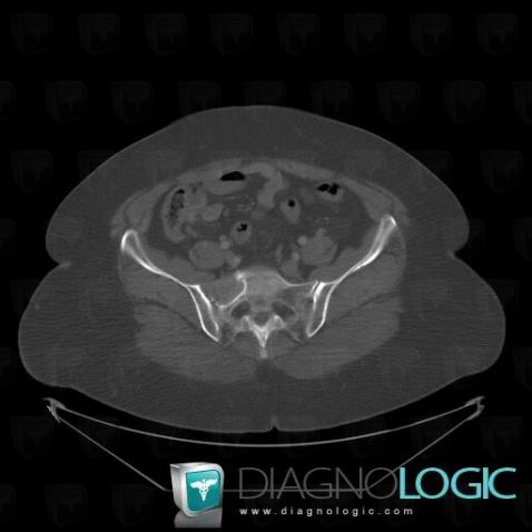 Metastasis, Sacrum / Coccyx, CT