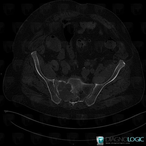 Metastasis, Sacrum / Coccyx, CT