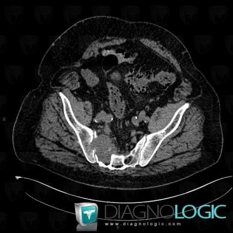 Metastasis, Sacrum / Coccyx, CT