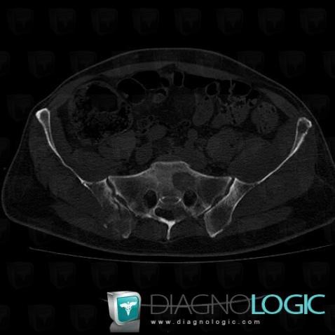 Metastasis, Sacrum / Coccyx, CT