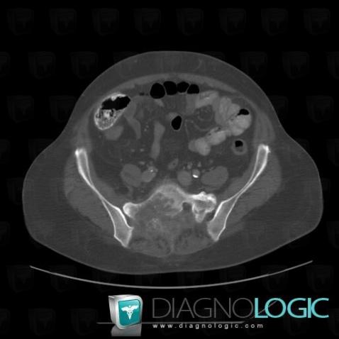 Metastasis, Sacrum / Coccyx, CT