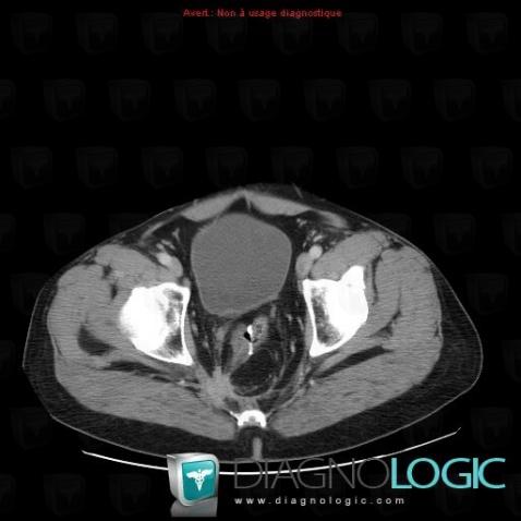 Metastasis, Sacrum / Coccyx, CT