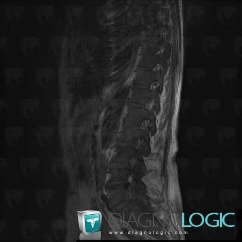 Metastasis, Sacrum / Coccyx, MRI