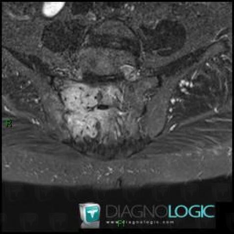 Metastasis, Sacrum / Coccyx, MRI