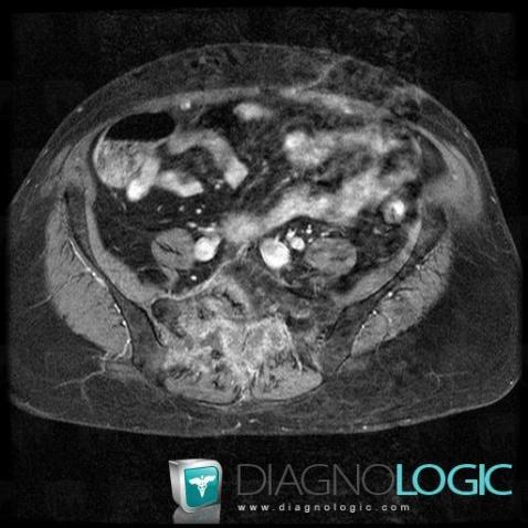 Metastasis, Sacrum / Coccyx, MRI