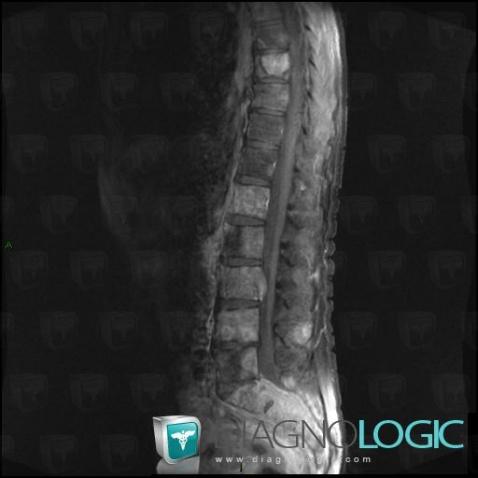 Metastasis, Sacrum / Coccyx, Vertebral body / Disk, MRI