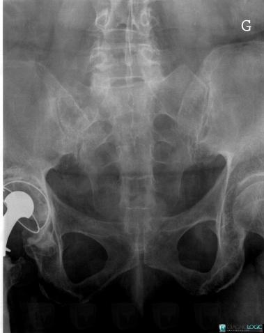 Metastasis, Sacrum / Coccyx, X rays