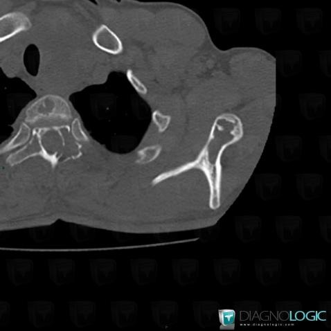 Metastasis, Scapula, CT