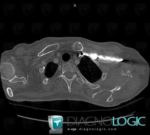 Metastasis, Scapula, CT