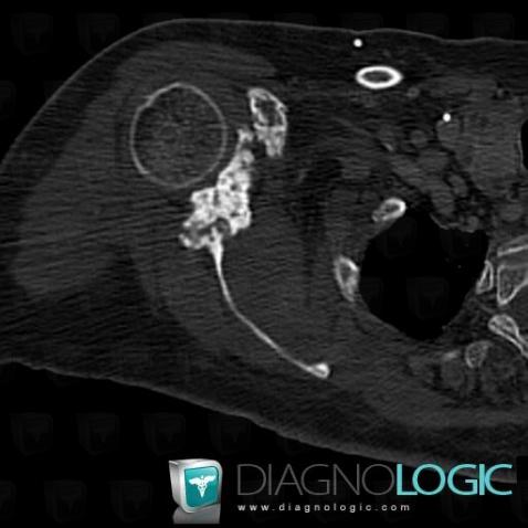 Metastasis, Scapula, CT