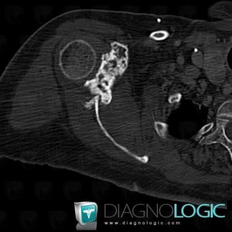 Metastasis, Scapula, CT