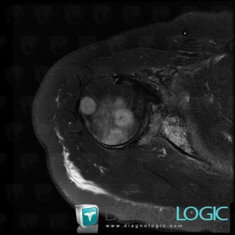 Metastasis, Scapula, Humerus - Proximal part, MRI