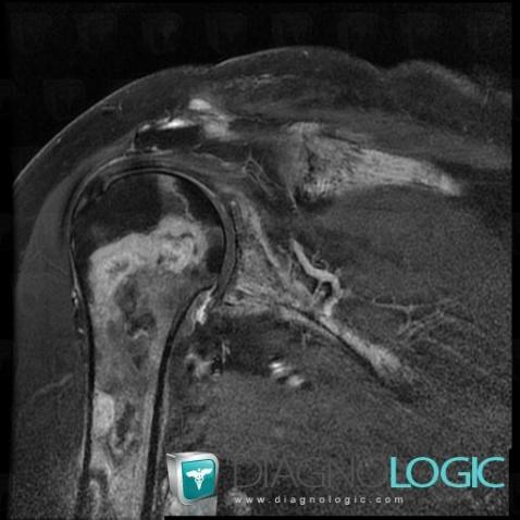 Metastasis, Scapula, MRI