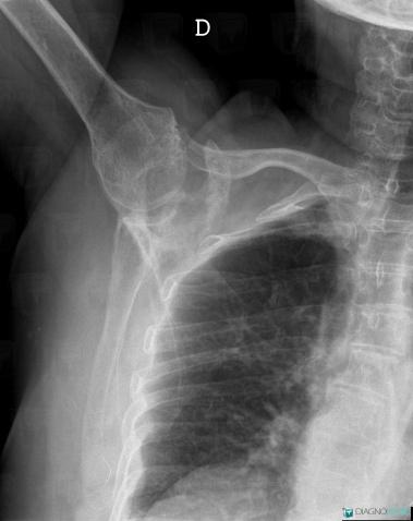 Metastasis, Scapula, X rays